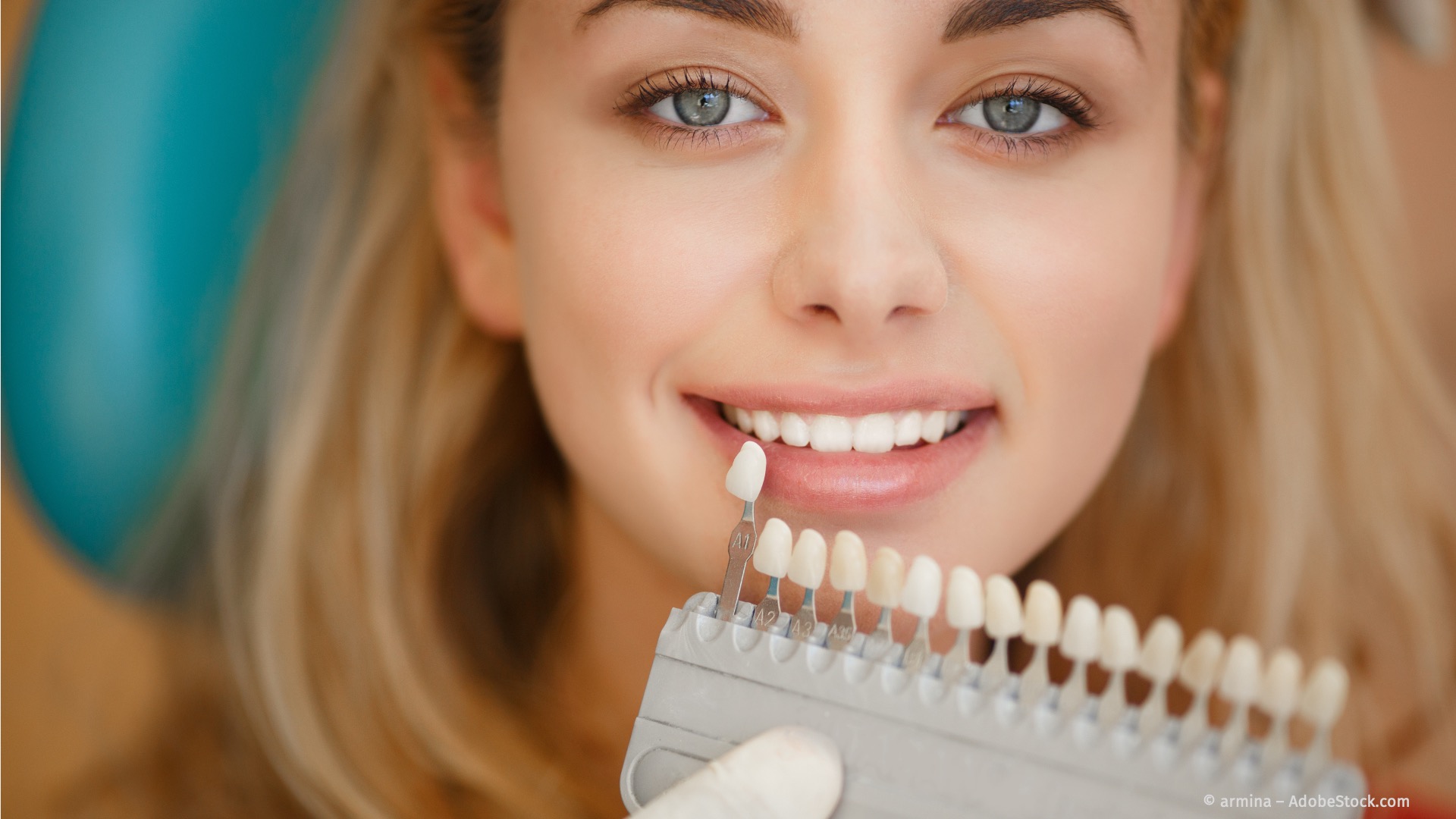 In-Office-Bleaching: Professionelle Zahnaufhellung in der Praxis