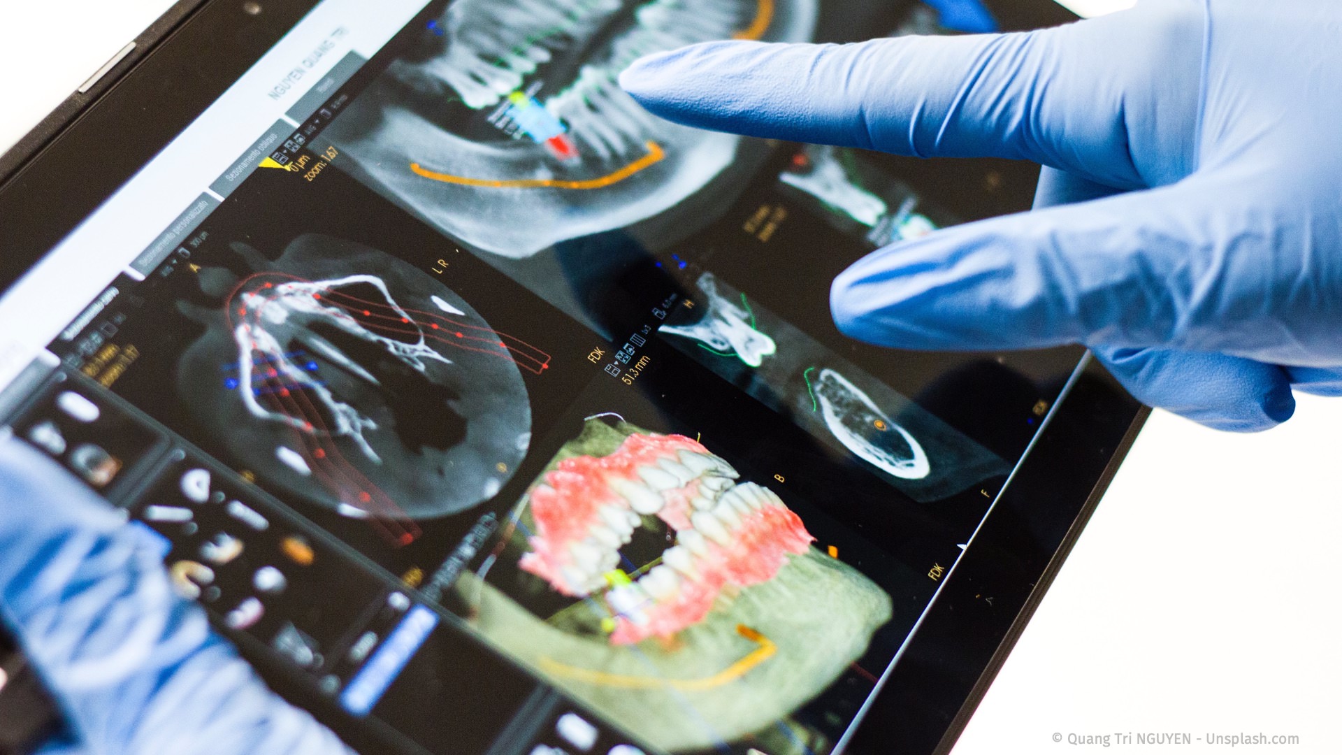 Computergestützte 3D-Implantatplanung