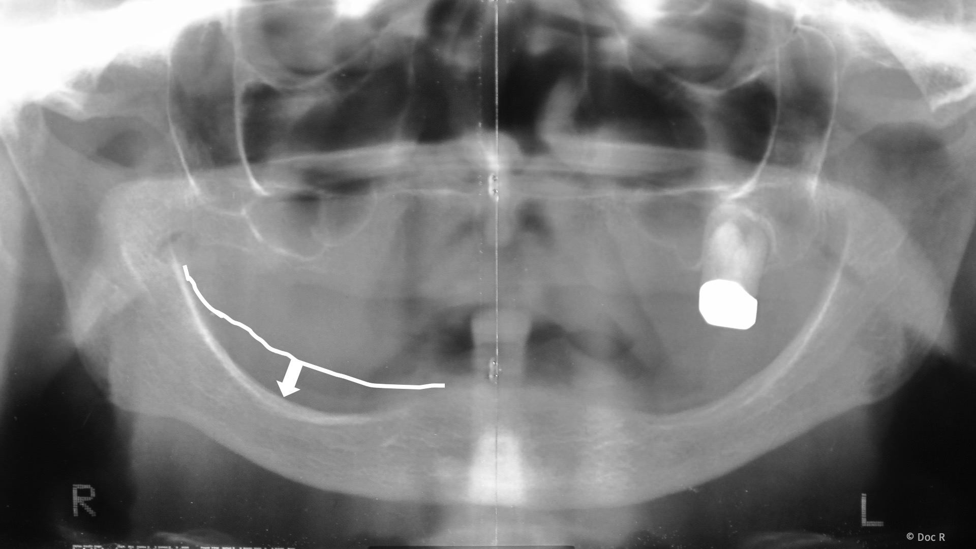 Kieferknochenaufbau, um Platz für Implantate zu schaffen